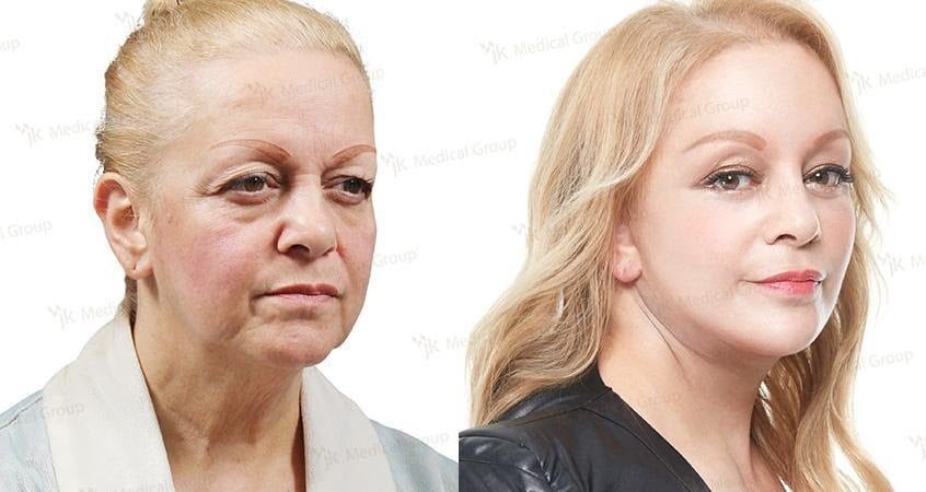 Results of anti-aging therapy