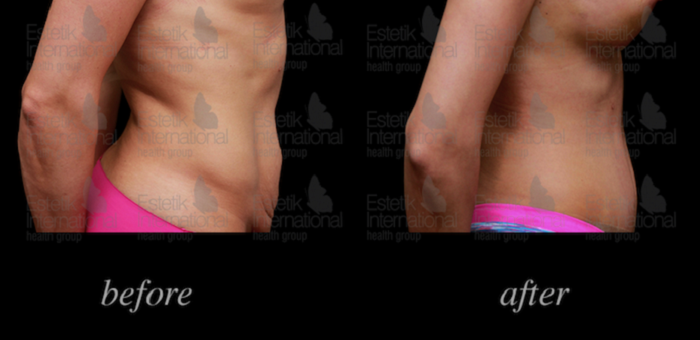 Tummy Tuck: Patient Guide and Surgery Overview, Before and After Photos  [Risks and Recovery]