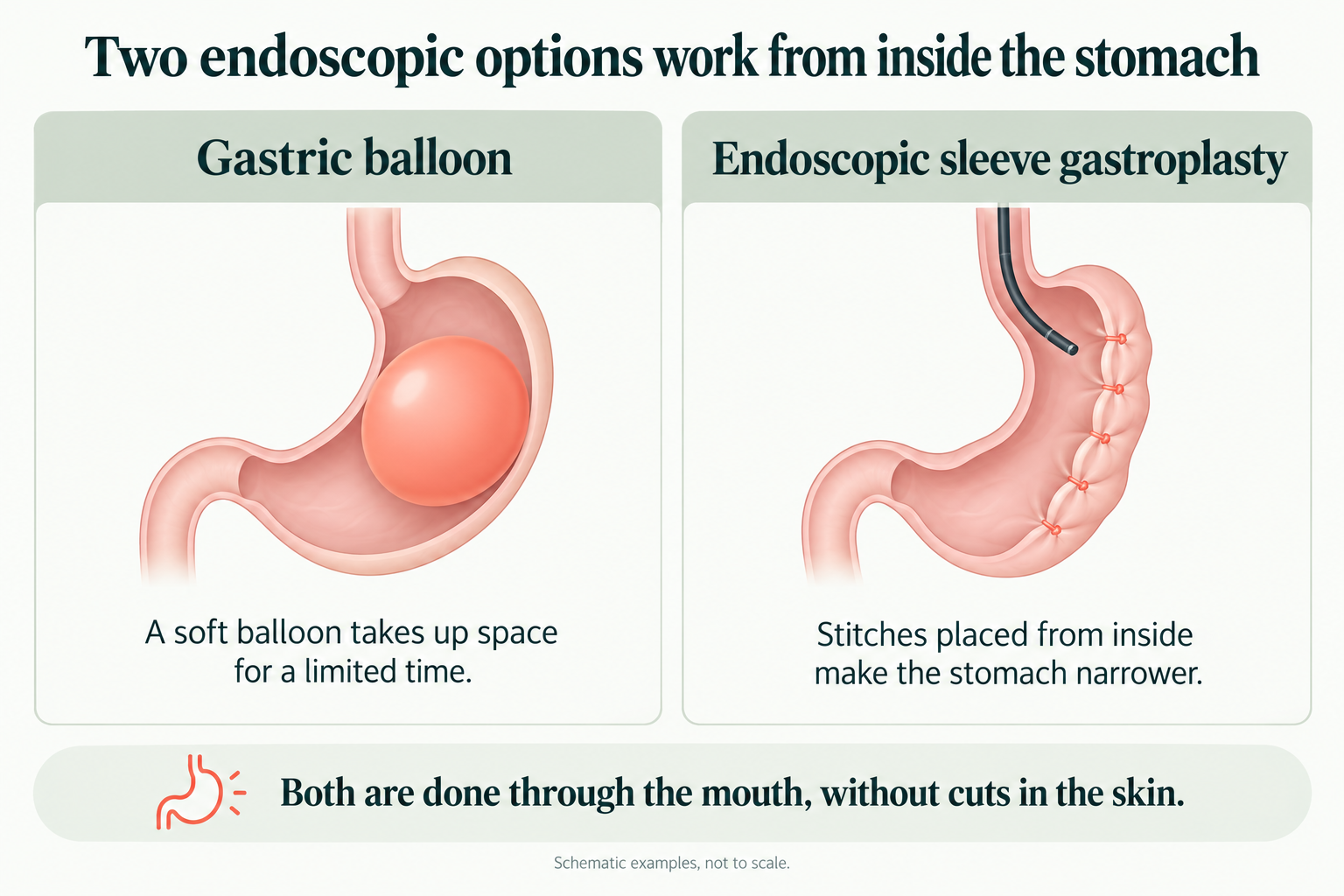Schematic: a gastric balloon inside the stomach and endoscopic sleeve gastroplasty stitches placed from inside