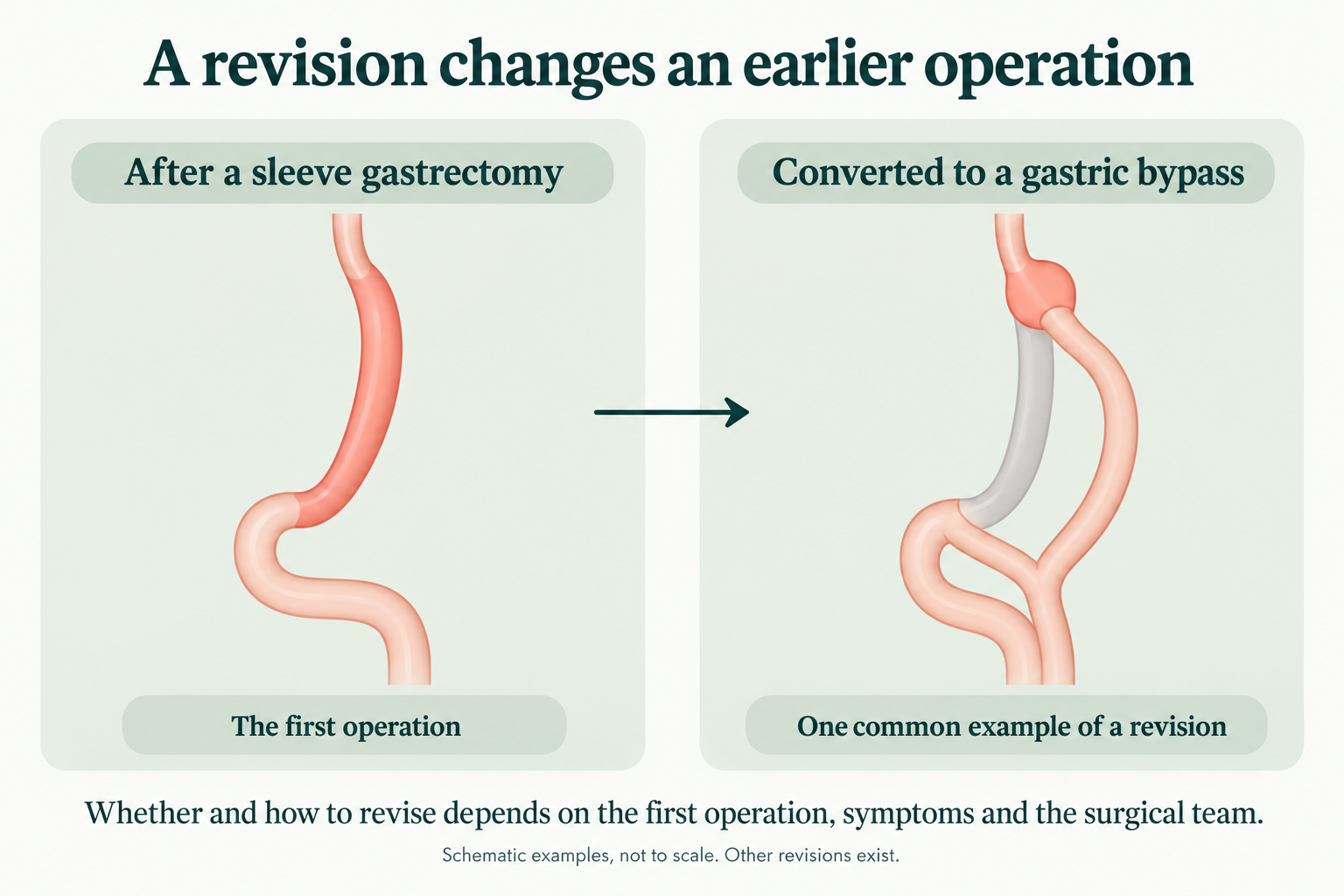 Schematic: a sleeve gastrectomy converted to a gastric bypass