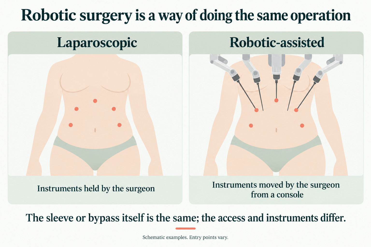 Schematic: the same small entry points for laparoscopic and robotic-assisted surgery